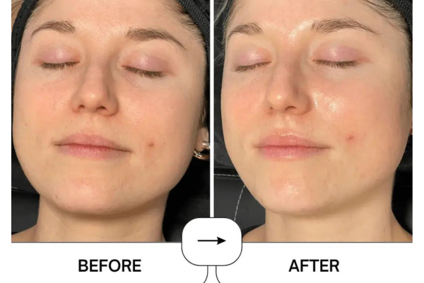 HydraFacial
